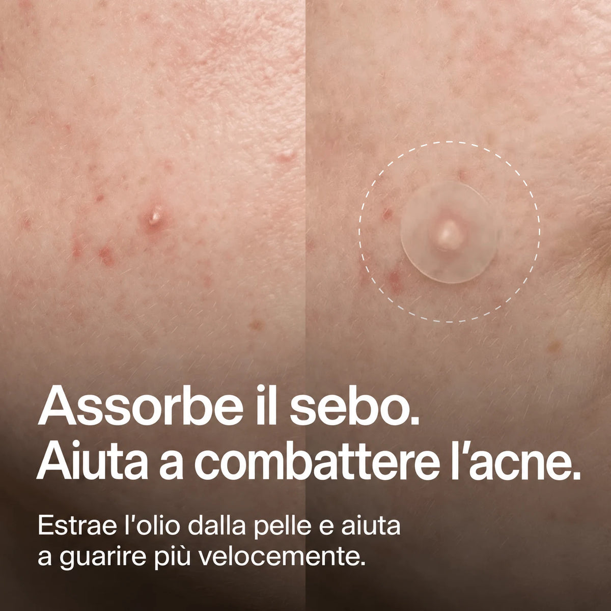 clear-dots-acne-patches gallery 2 (it)