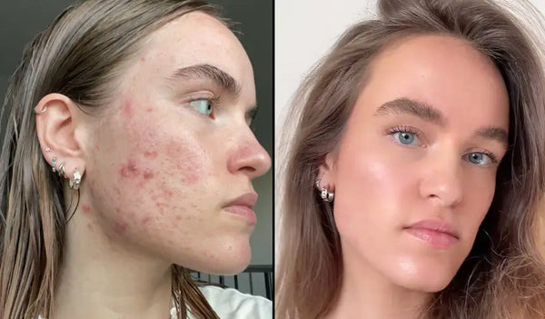 Finalmente qualcosa che funziona contro l'acne ormonale
