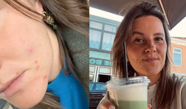 Dopo aver smesso la pillola, la mia pelle è esplosa.