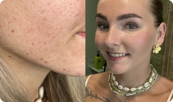 Le macchie rosse spariscono più velocemente