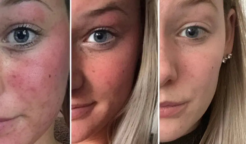Lisa before and after 7 weeks of Clear+