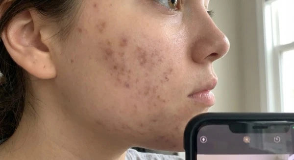Dark marks or post-acne scarring